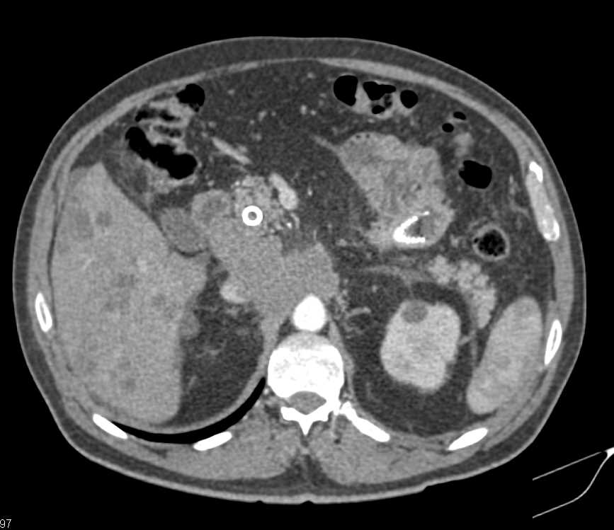 Pancreatic Cancer invades Duodenum with Liver Metastases - CTisus CT Scan