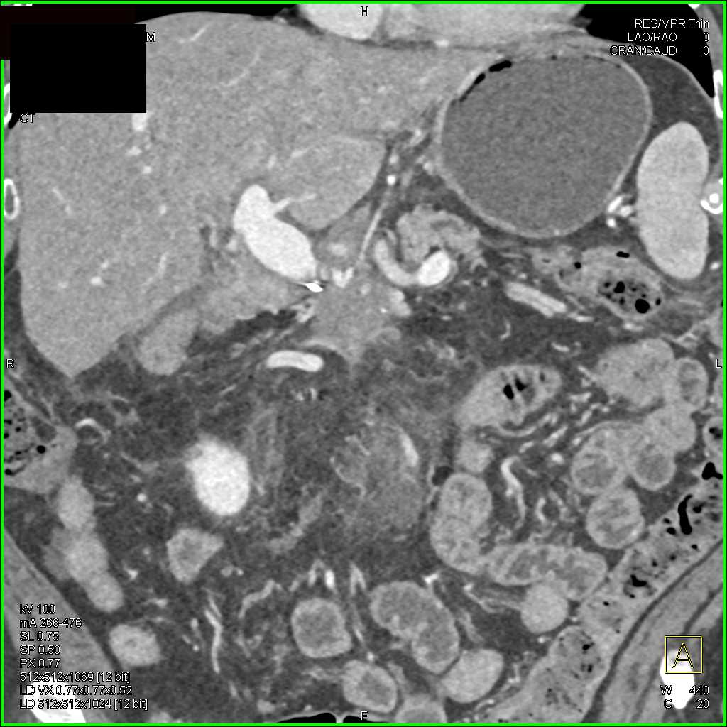 Invasive Carcinoma Head of Pancreas - CTisus CT Scan