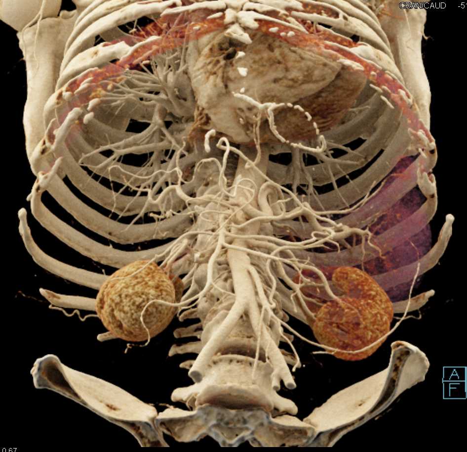 Carcinoma Head of Pancreas - CTisus CT Scan