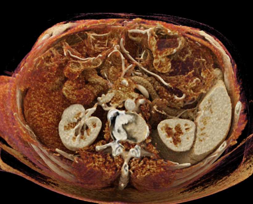 Carcinoma Head of Pancreas - CTisus CT Scan