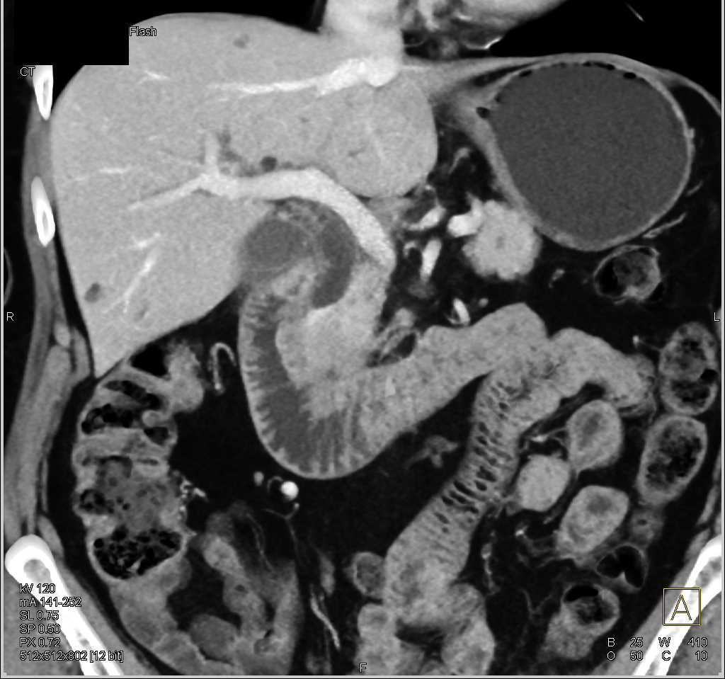 Carcinoma Head of Pancreas Obstructs the Common Bile Duct (CBD) - CTisus CT Scan
