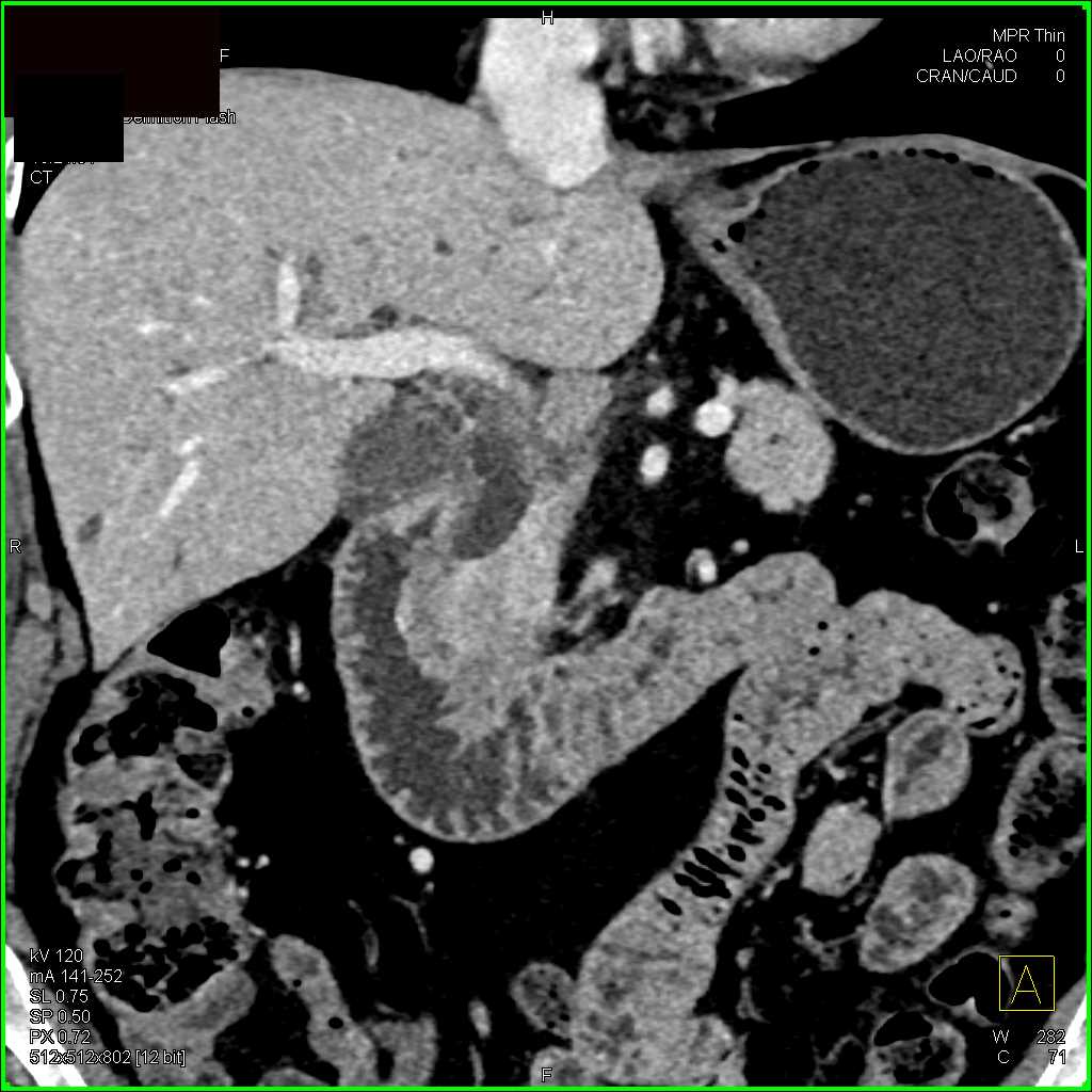 Carcinoma Head of Pancreas Obstructs the Common Bile Duct (CBD) - CTisus CT Scan