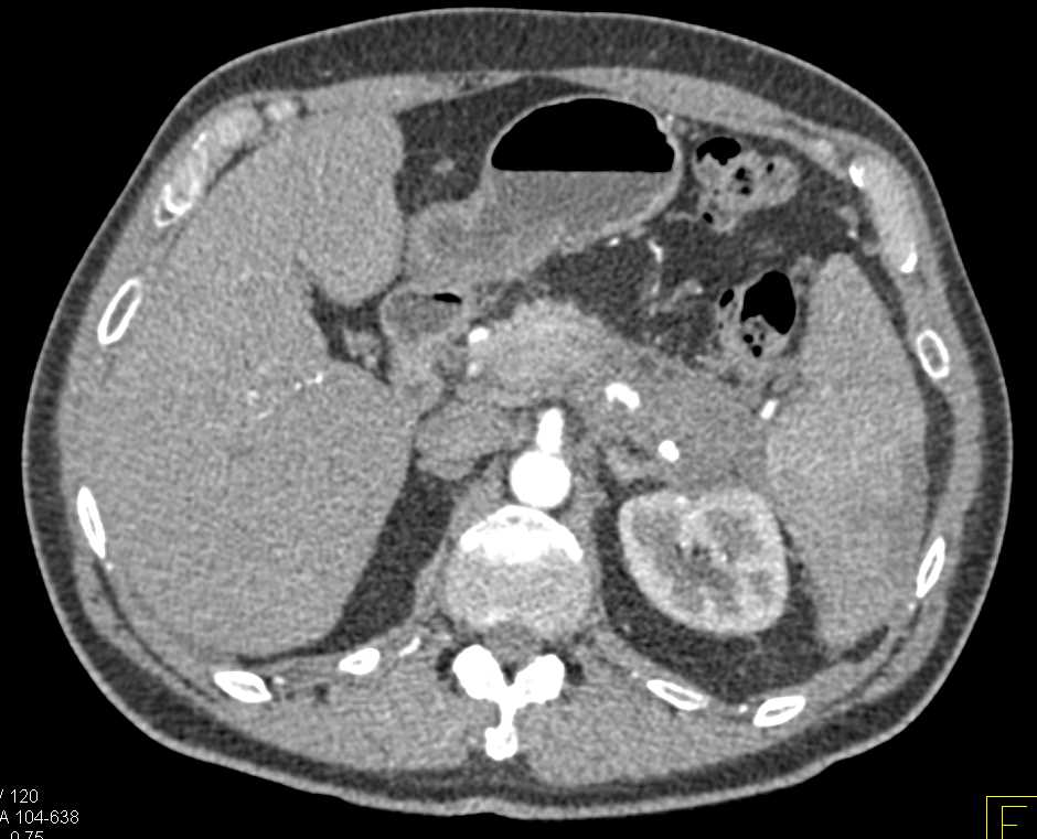 Carcinoma Tail of Pancreas - CTisus CT Scan