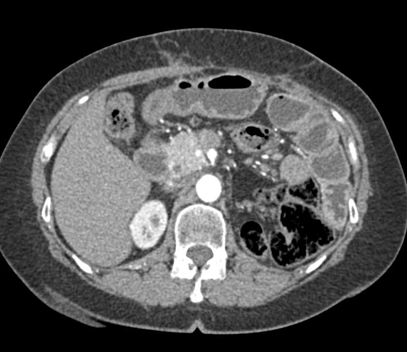 Neuroendocrine Tumor Head of Pancreas - CTisus CT Scan