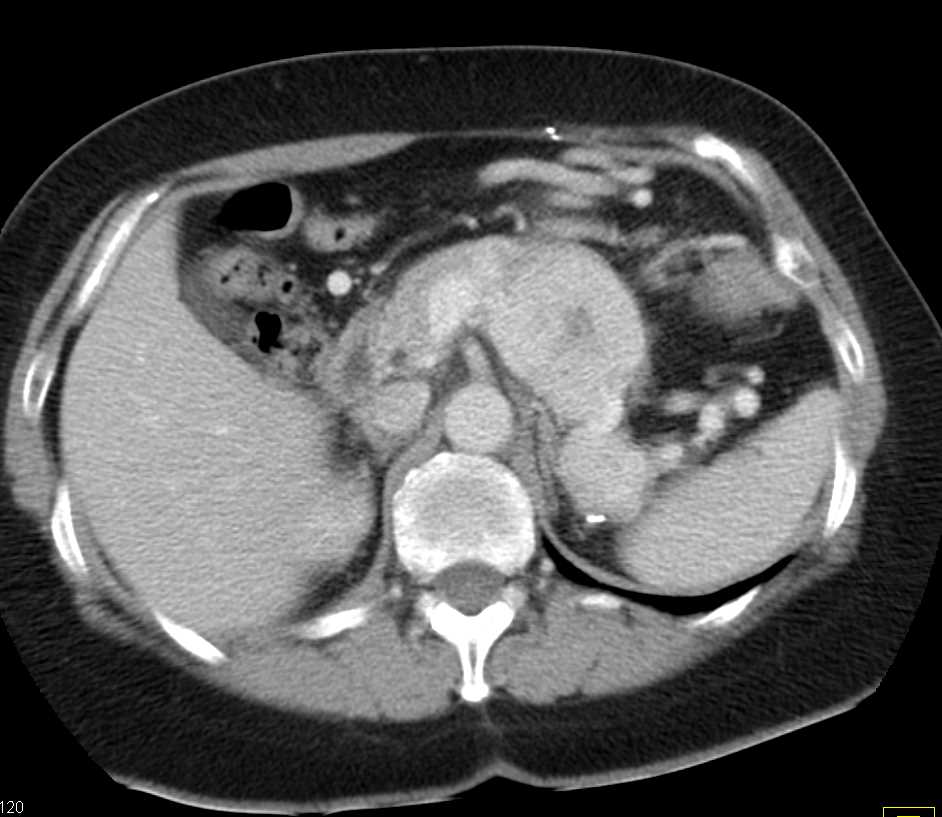 Neuroendocrine Tumor Body and Tail of Pancreas - CTisus CT Scan