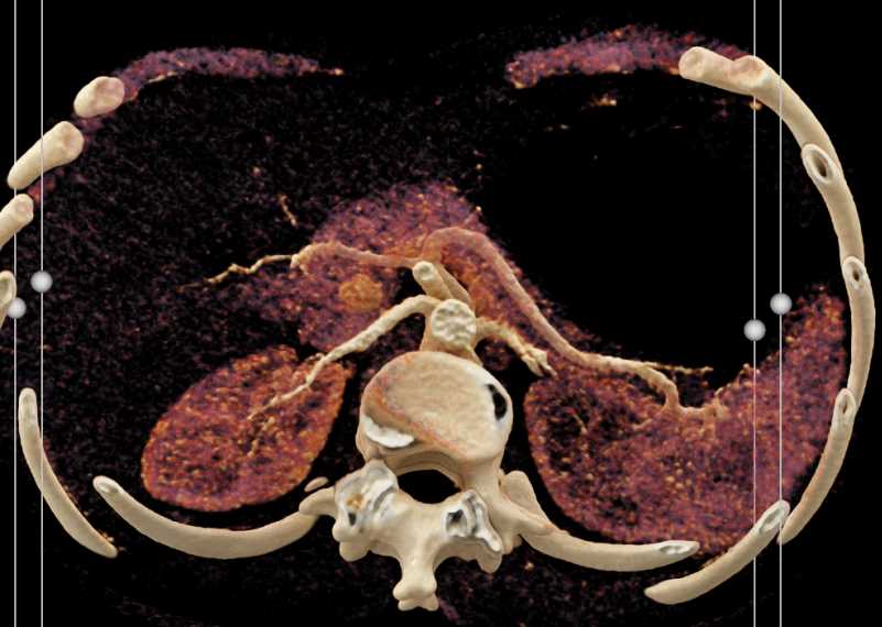 Neuroendocrine Tumor in the Head of the Pancreas with Cinematic Rendering - CTisus CT Scan