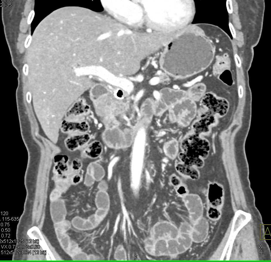 Carcinoma in the Head of the Pancreas with Stent in the Common Bile Duct (CBD) - CTisus CT Scan