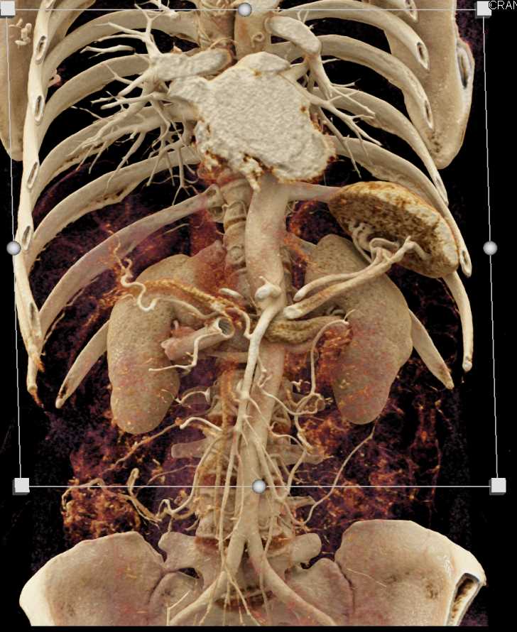 Carcinoma in the Head of the Pancreas with Stent in the Common Bile Duct (CBD) - CTisus CT Scan