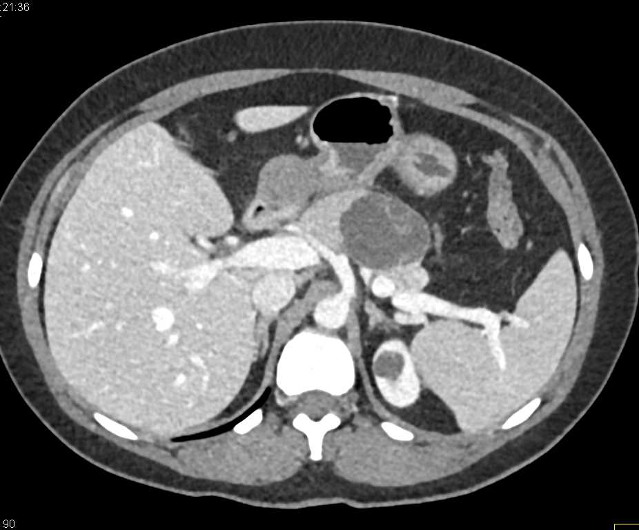 Mucinous Cystic Neoplasm (MCN) Body of the Pancreas - CTisus CT Scan