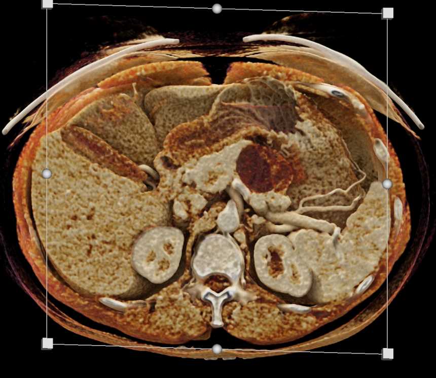 Mucinous Cystic Neoplasm (MCN) Body of the Pancreas - CTisus CT Scan