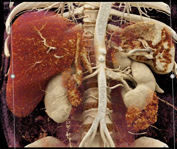 Mucinous Cystic Neoplasm (MCN) Body of the Pancreas - CTisus CT Scan