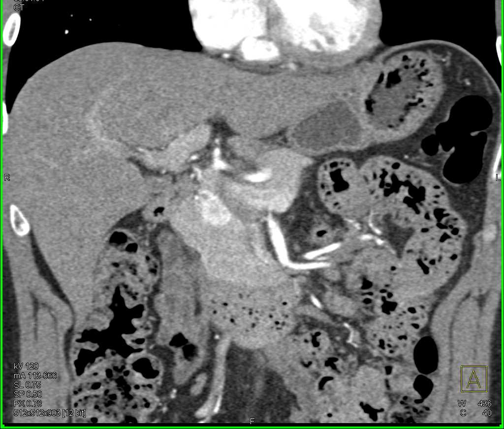 2cm Pancreatic Neuroendocrine Tumor (PNET) Head of Pancreas - CTisus CT Scan