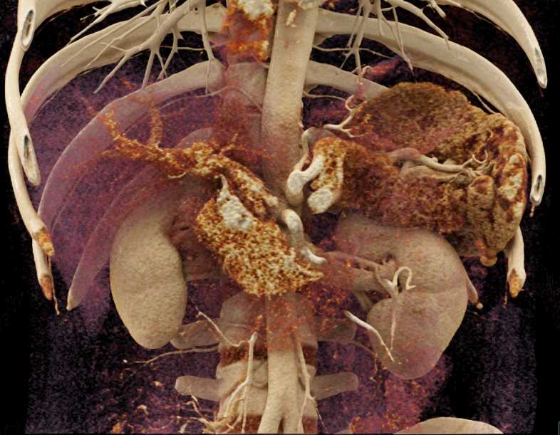 2cm Pancreatic Neuroendocrine Tumor (PNET) Head of Pancreas - CTisus CT Scan