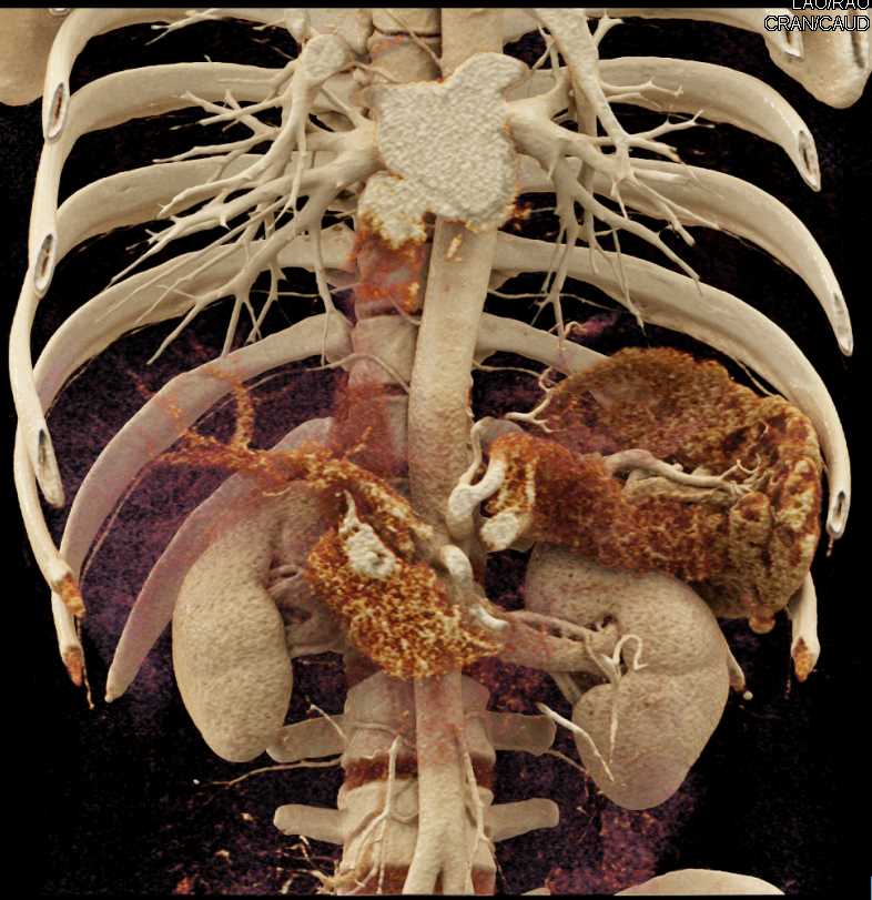 2cm Pancreatic Neuroendocrine Tumor (PNET) Head of Pancreas - CTisus CT Scan