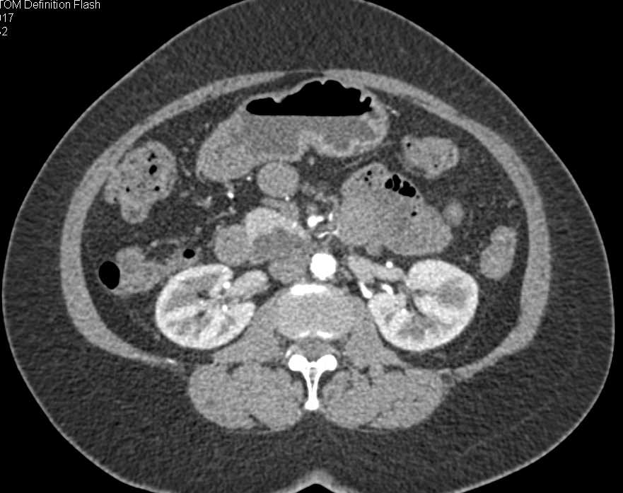 Intraductal Papillary Mucinous Neoplasm (IPMN) Pancreas - CTisus CT Scan