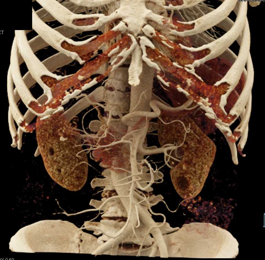 Carcinoma of the Pancreas - CTisus CT Scan