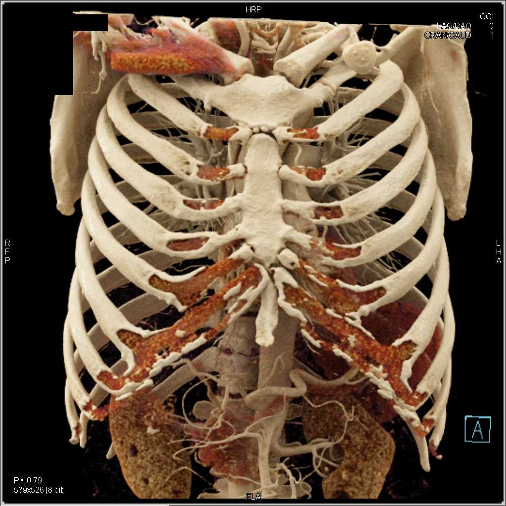 Pancreatic Cancer with Vascular Encasement Involves the PV/SMV Junction with Cinematic Rendering - CTisus CT Scan