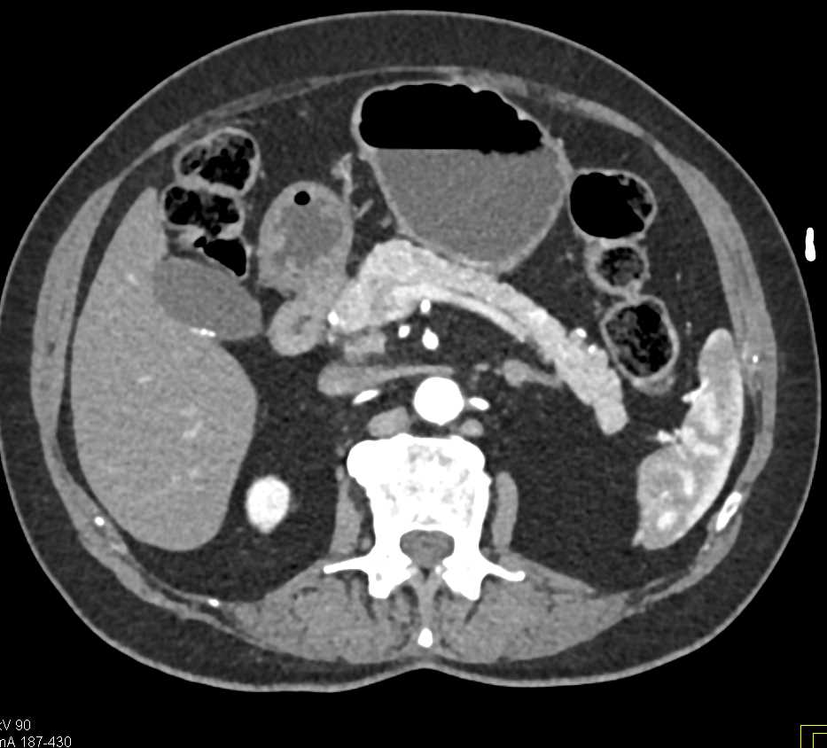 Incidental Pancreatic Neuroendocrine Tumor (PNET) in Body of the Pancreas - CTisus CT Scan