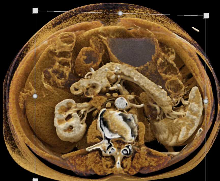 Incidental Pancreatic Neuroendocrine Tumor (PNET) in Body of the Pancreas - CTisus CT Scan