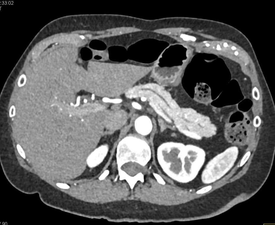 Pancreatic Enhancement - CTisus CT Scan
