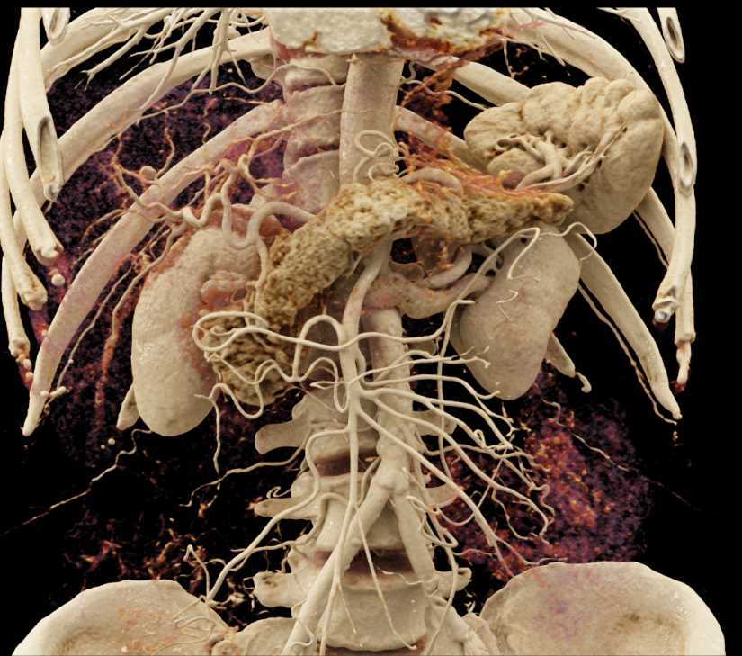 Incidental Pancreatic Neuroendocrine Tumor (PNET) in Body of the Pancreas - CTisus CT Scan