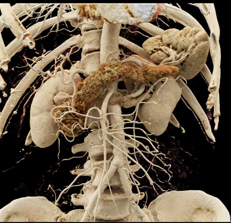 Incidental Pancreatic Neuroendocrine Tumor (PNET) in Body of the Pancreas - CTisus CT Scan