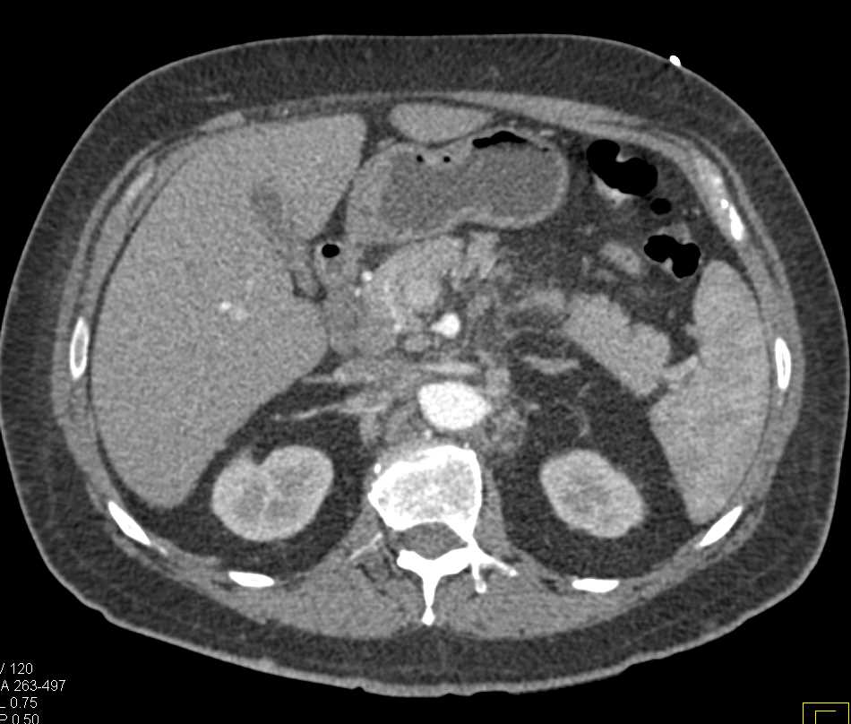 Acute Pancreatitis and Mesenteric Nodes - CTisus CT Scan