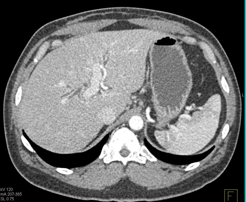 Subtle Pancreatic Cancer - CTisus CT Scan