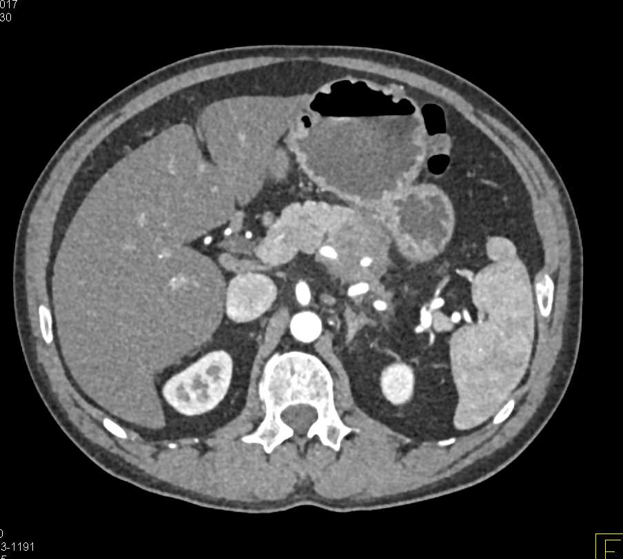 Carcinoma of the Pancreas - CTisus CT Scan