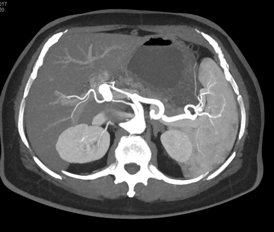 Pancreas Cancer with Common Bile Duct (CBD) Stent - CTisus CT Scan