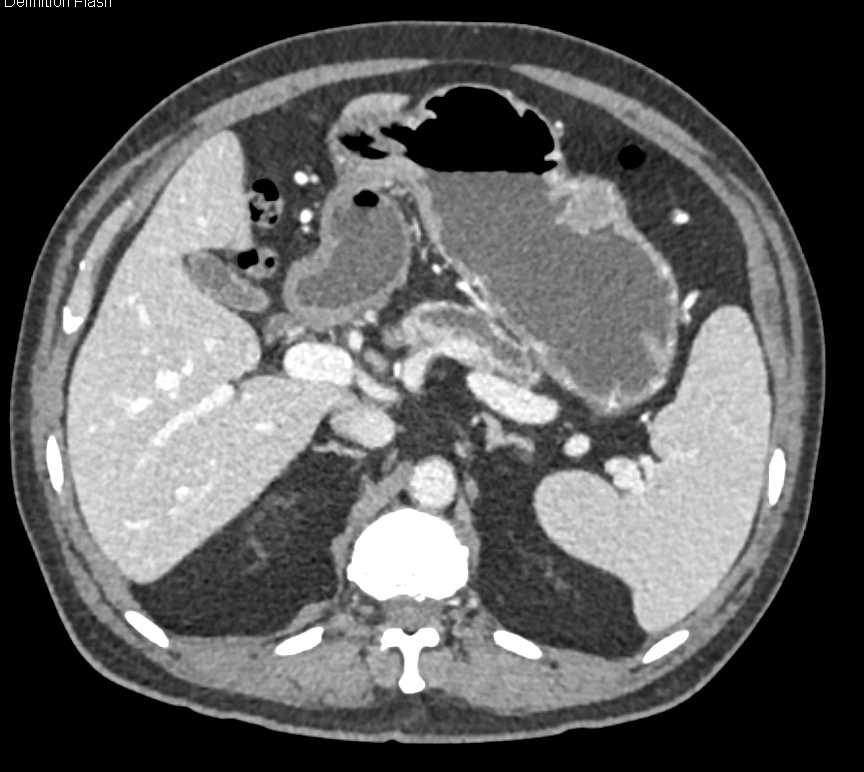 Pancreatic Cancer with Dilated Pancreatic Duct and Incidental GIST Tumor Stomach - CTisus CT Scan