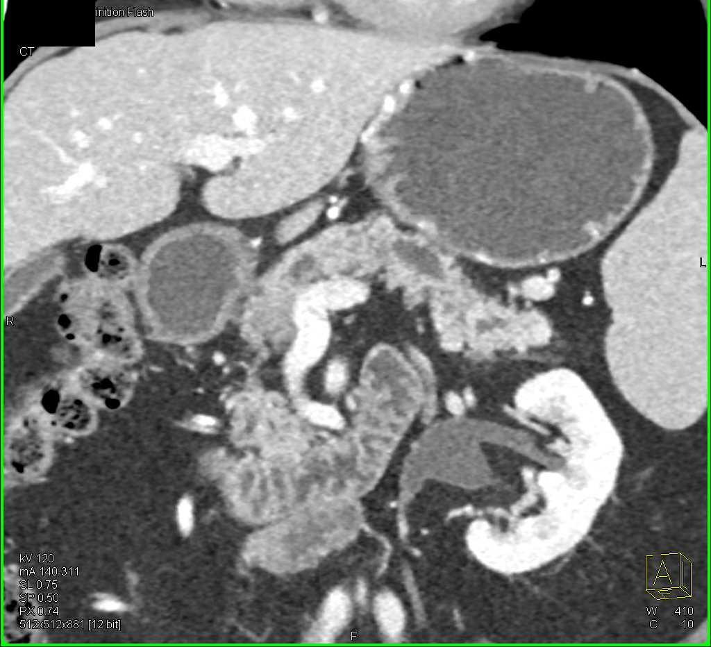 Pancreatic Cancer with Dilated Pancreatic Duct and Incidental GIST Tumor Stomach - CTisus CT Scan