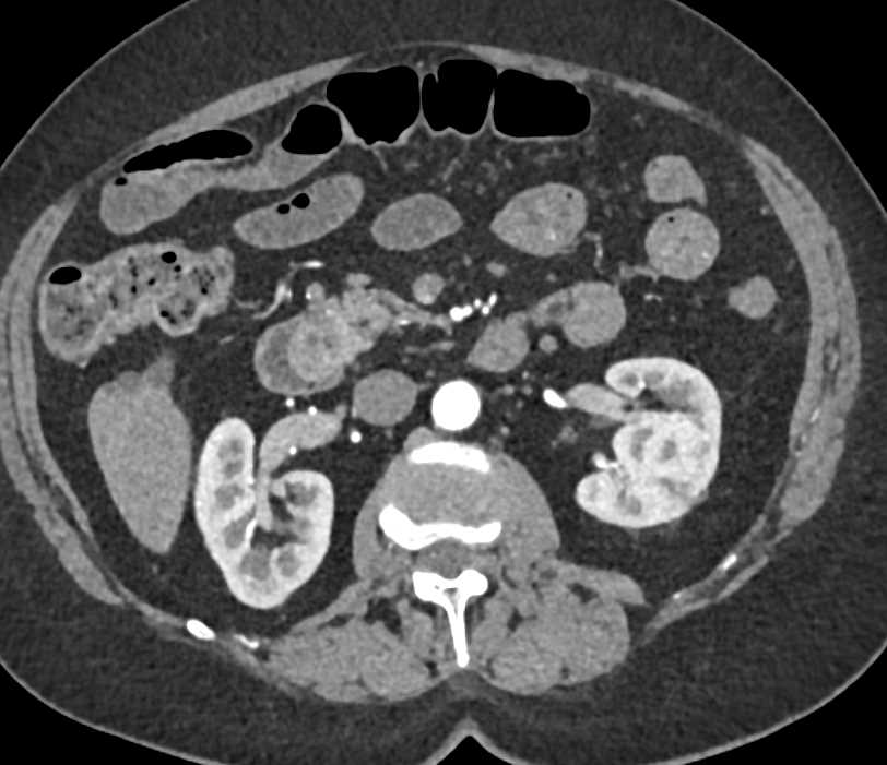 Ampullary Carcinoma - CTisus CT Scan