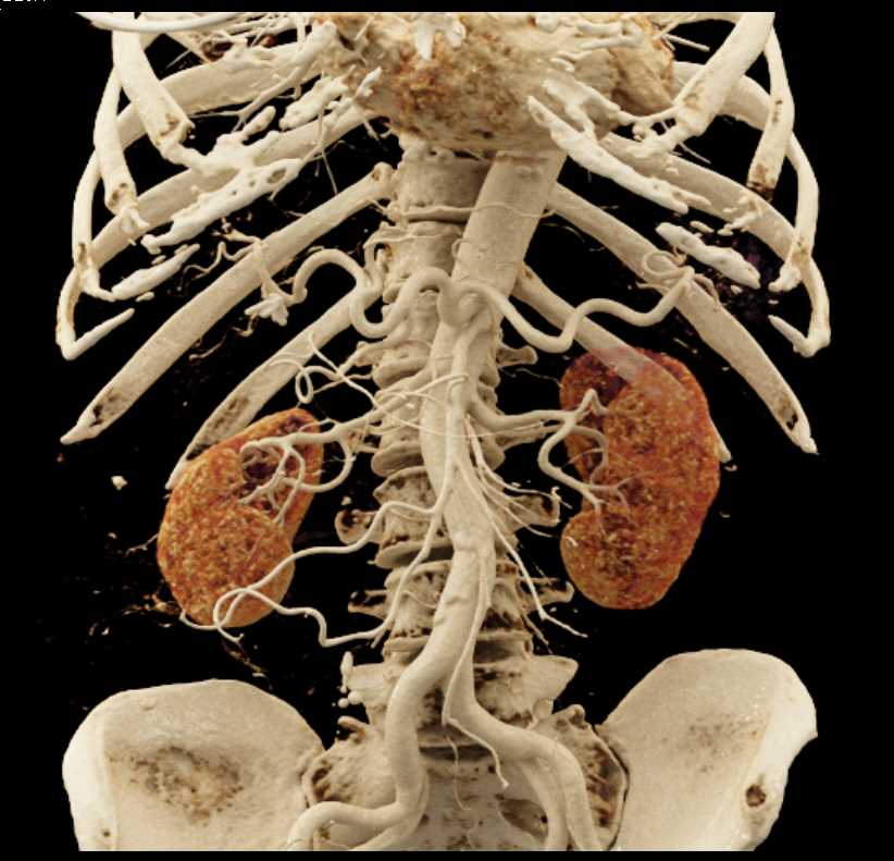 Ampullary Carcinoma - CTisus CT Scan