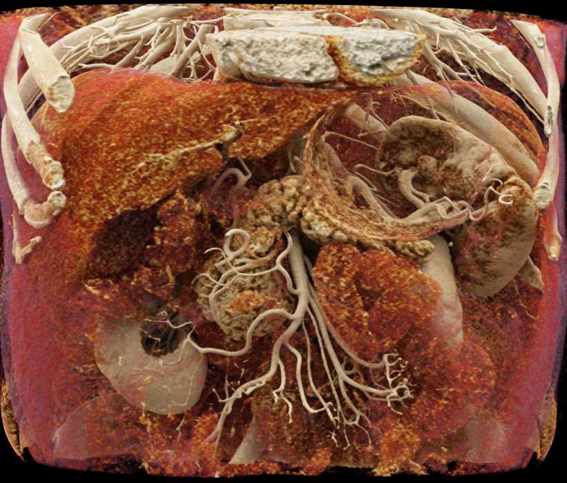 Intraductal Papillary Mucinous Neoplasm (IPMN) Head of Pancreas - CTisus CT Scan