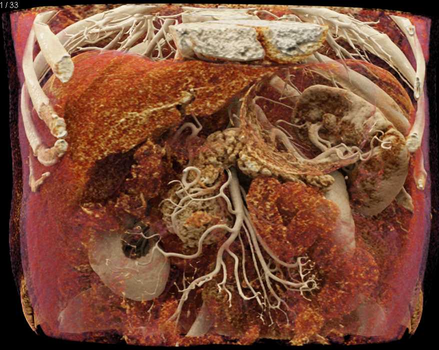 Intraductal Papillary Mucinous Neoplasm (IPMN) Head of Pancreas - CTisus CT Scan