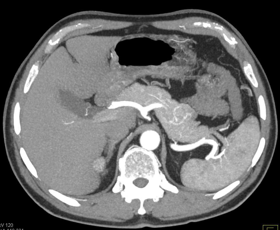 Neuroendocrine Tumor in the Tail of the Pancreas - CTisus CT Scan