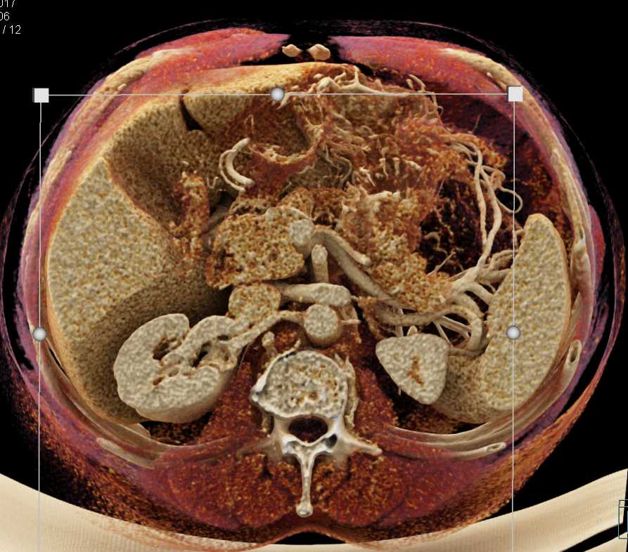 Neuroendocrine Tumor in the Tail of the Pancreas with Cinematic Rendering - CTisus CT Scan