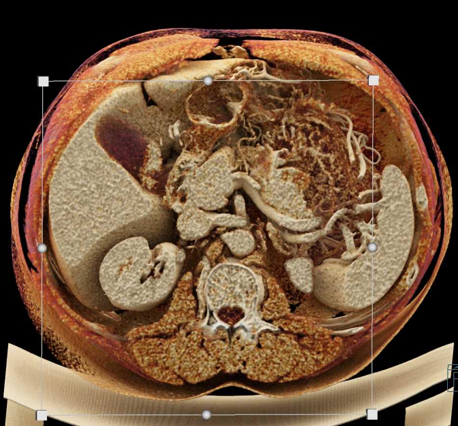 Neuroendocrine Tumor in the Tail of the Pancreas with Cinematic Rendering - CTisus CT Scan