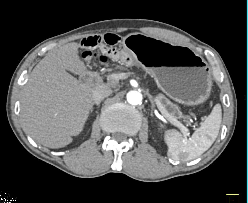 Main Duct Intraductal Papillary Mucinous Neoplasm (IPMN) Tail of Pancreas - CTisus CT Scan