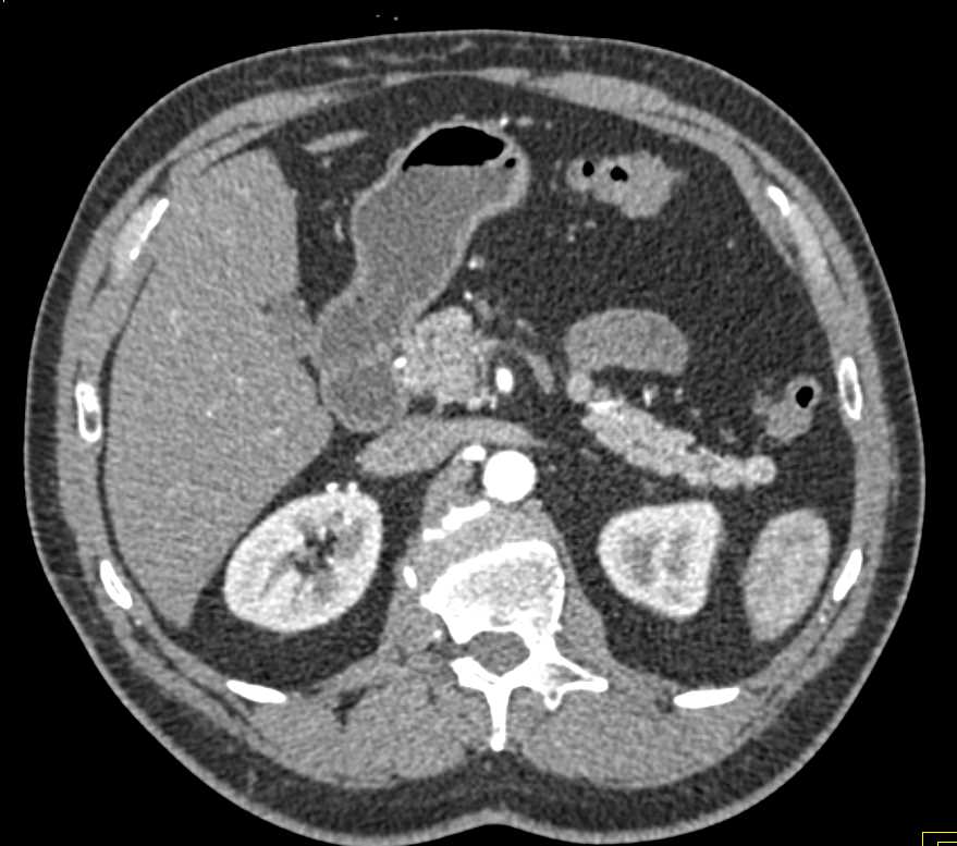 Pancreatic Neuroendocrine Tumor (PNET) Tail of Pancreas - CTisus CT Scan