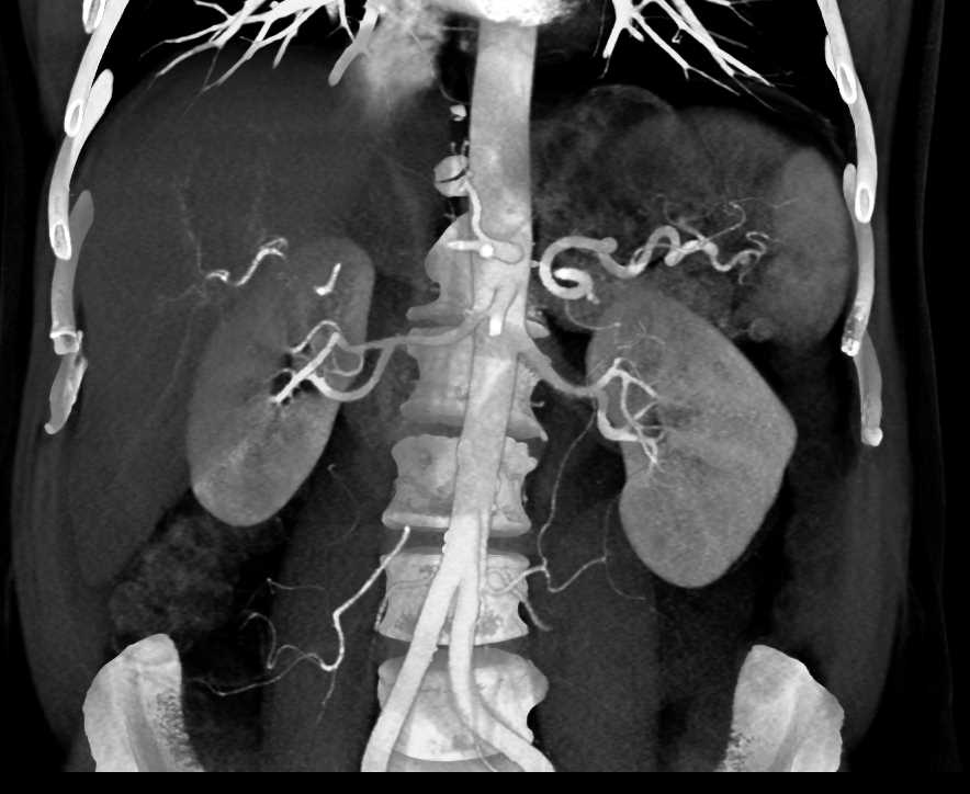 Pancreatic Neuroendocrine Tumor (PNET) Tail of Pancreas - CTisus CT Scan