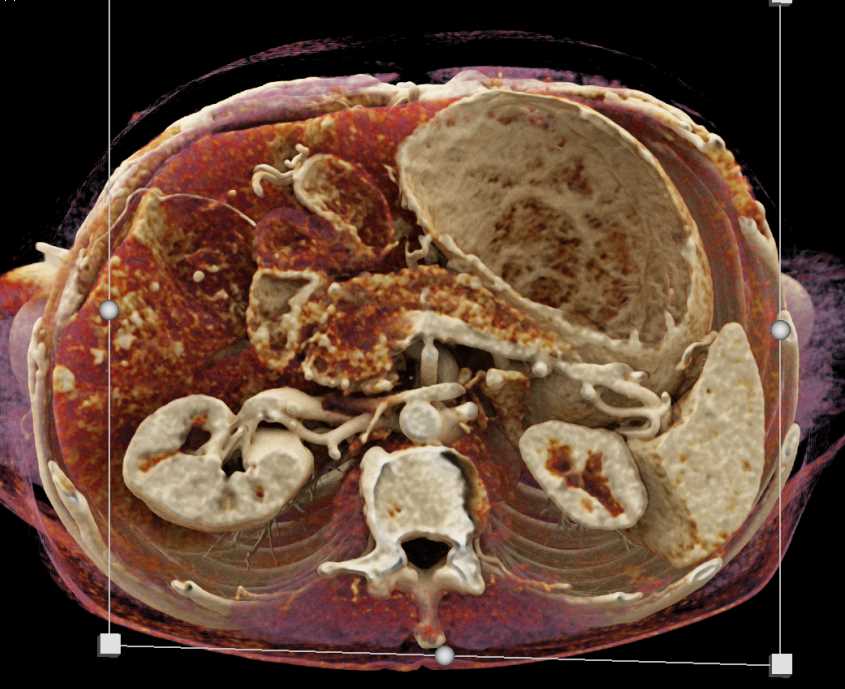 Pancreatic Cancer and Liver Metastasis with Cinematic Rendering - CTisus CT Scan