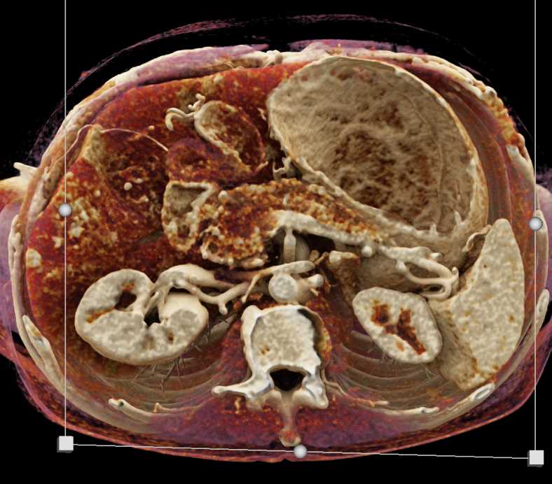 Staging Pancreatic Adenocarcinoma - CTisus CT Scan