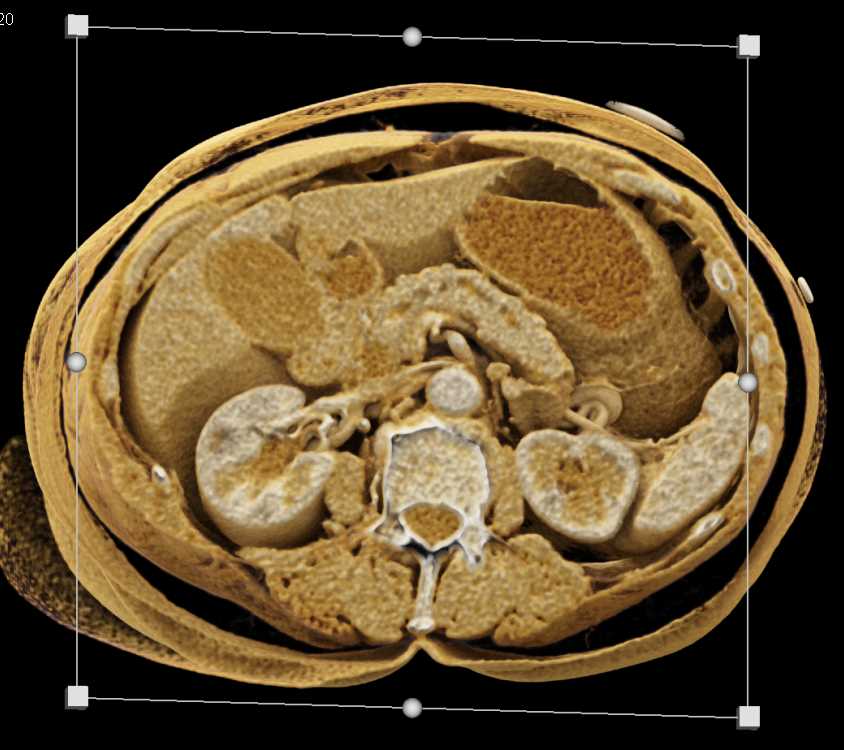 Pancreatic Adenocarcinoma - CTisus CT Scan