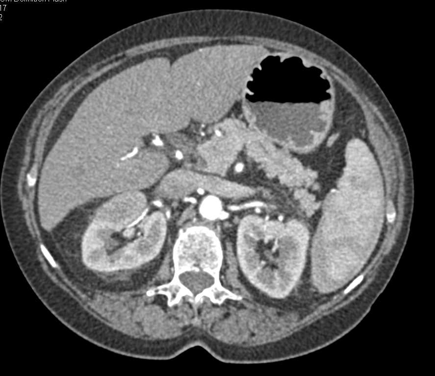 Subtle Pancreatic Adenocarcinoma - CTisus CT Scan