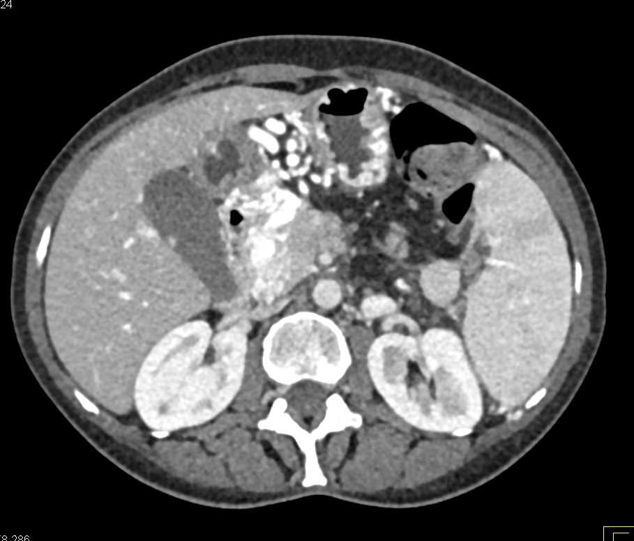 Pancreatic Adenocarcinoma with Portal Vein Occlusion and Collaterals - CTisus CT Scan