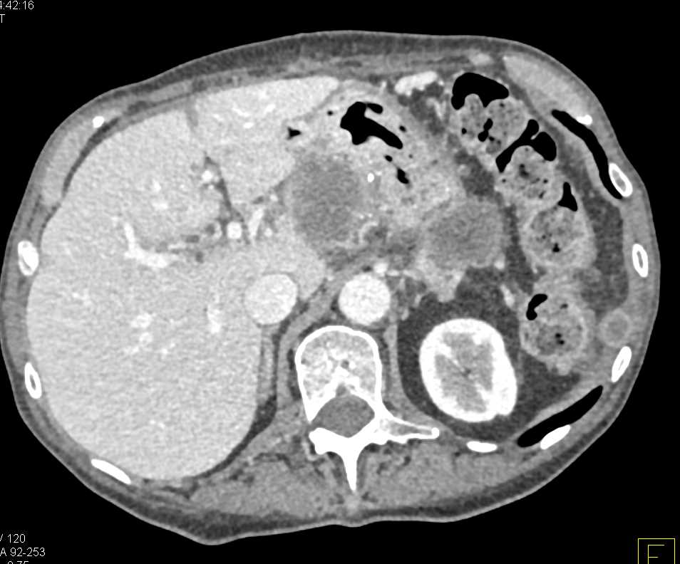 Pancreas Cancer with Metastases to the Left Rectus Muscle - CTisus CT Scan