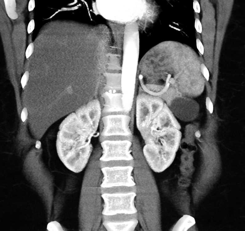 Lymphoepithelial Cyst Tail of Pancreas - CTisus CT Scan