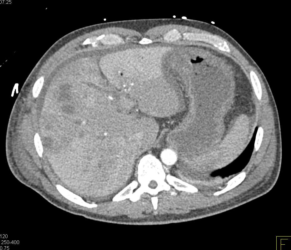 Pancreatic Cancer with Liver Metastases - CTisus CT Scan